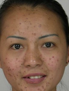 痤疮的治疗方法