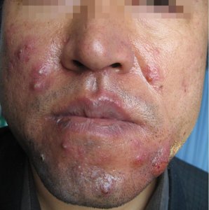 毛囊炎症状图片